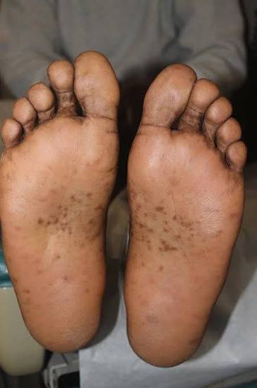 Si kweli: Madoa meusi kwenye nyayo huashiria maambukizi ya VVU